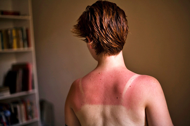 Sunburn normally takes eight to 10 hours to appear Sunburn normally takes eight to 10 hours to appear